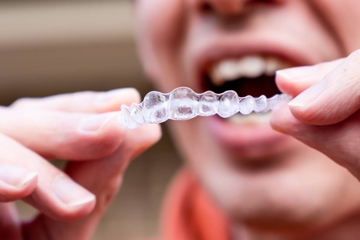 clear retainer braces