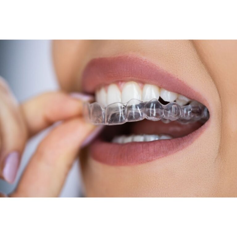 Woman with beautiful teeth is seen putting on her clear aligners.