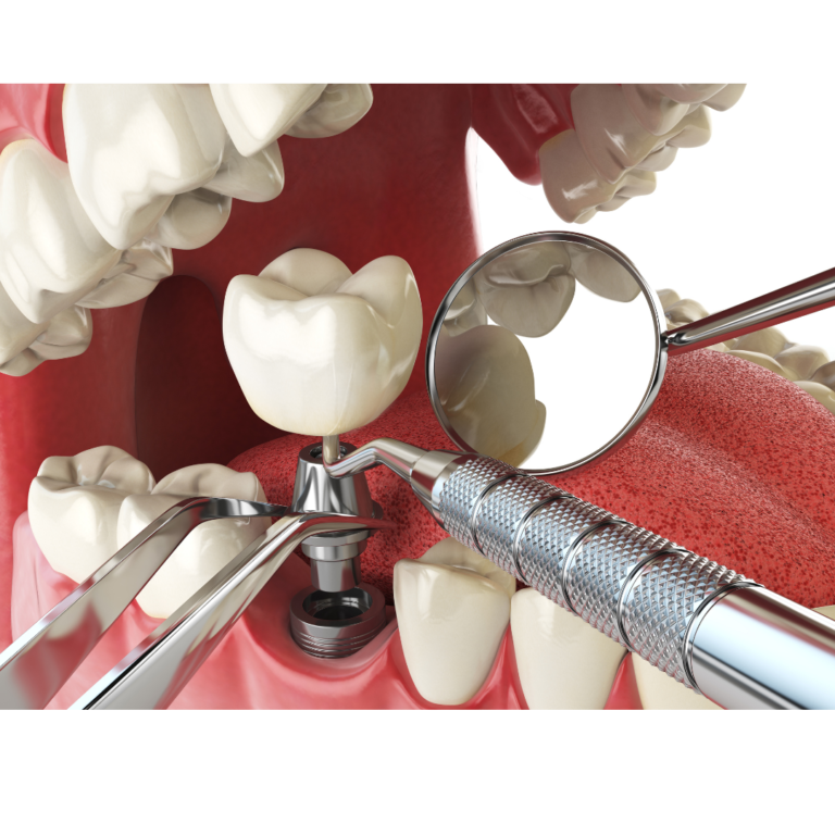 Dental implants from the expert team at Ames Dentistry