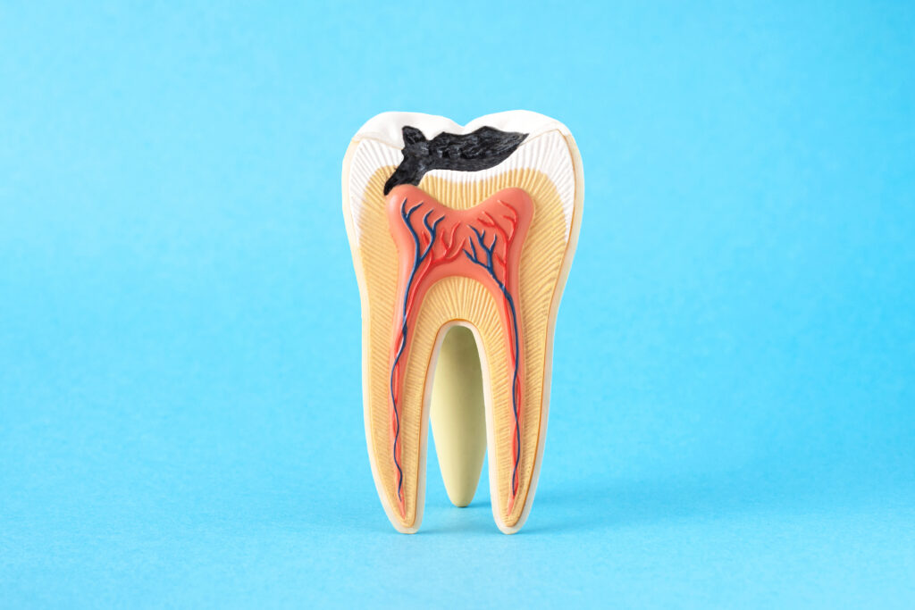 Cavity requires dental filling in Wilmington