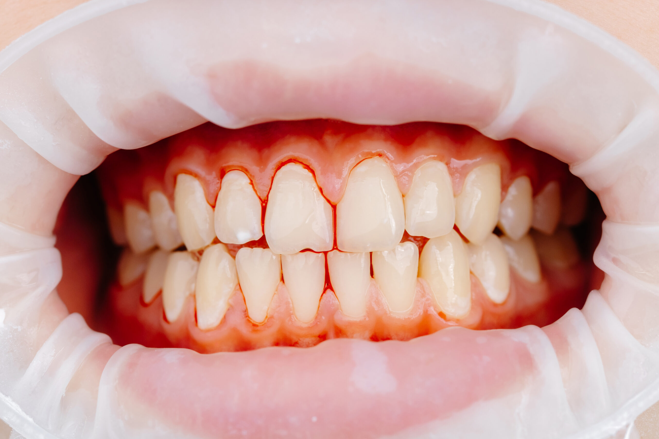 early signs of gum disease