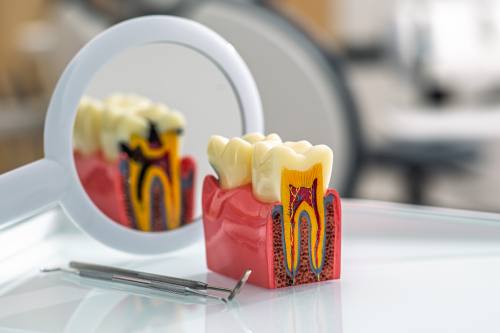 tooth filling at Ames Dentistry